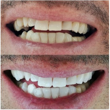 הלבנת שיניים - תמונה של לפני ואחרי הטיפול