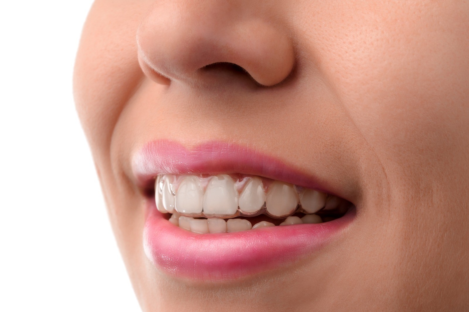 יישור שיניים באמצעות פלטות שקופות בלי שאף אחד יבחין שאתם בתהליך טיפול